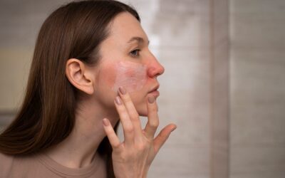 Érzékeny, rosaceás bőr kezelése